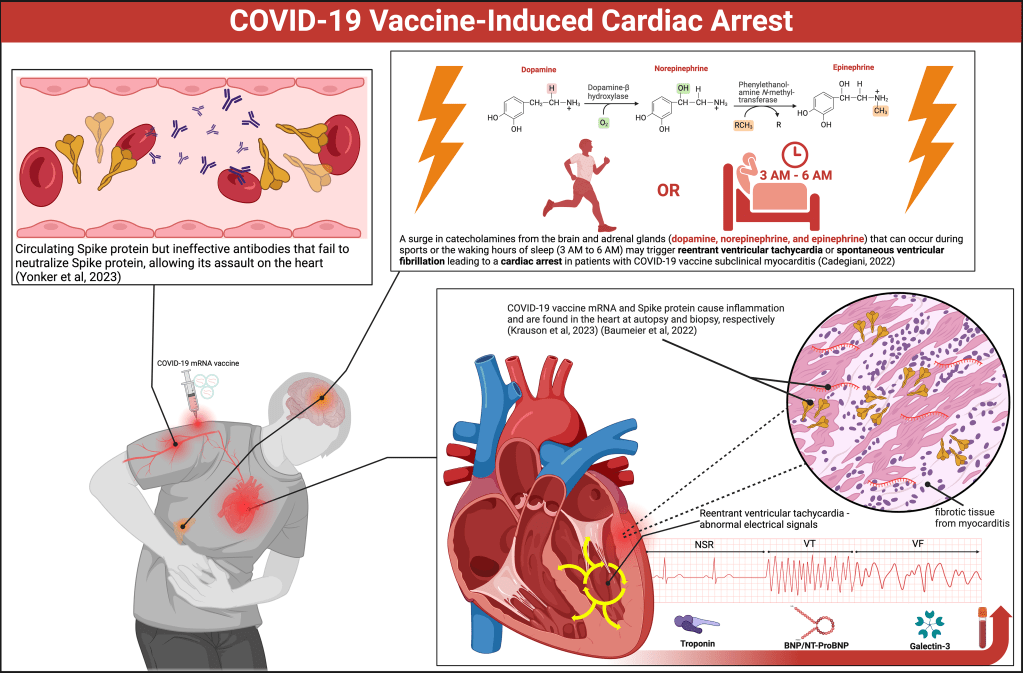 Primo protocollo di stratificazione del rischio sottoposto a revisione paritaria per un futuro arresto cardiaco dopo la vaccinazione&nbsp;COVID-19
